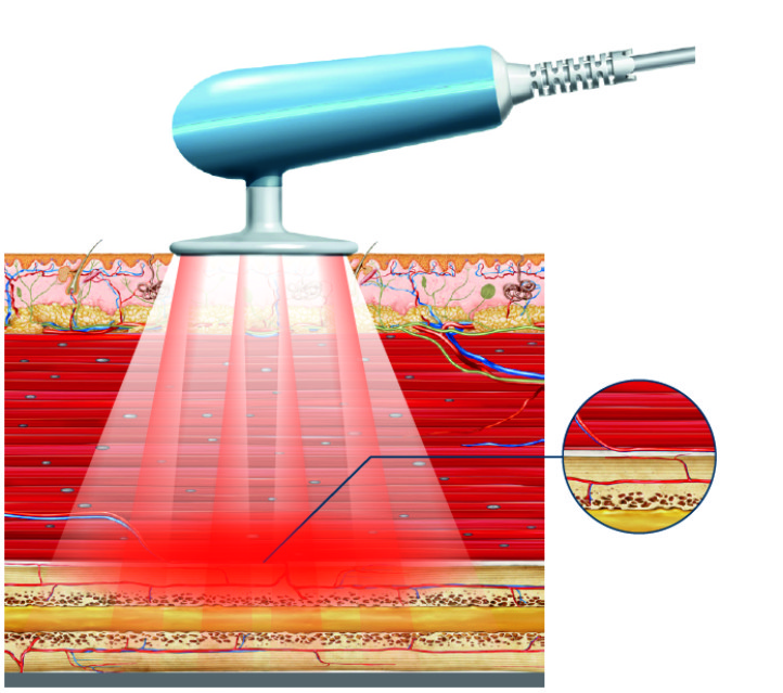 Radiofrequenztherapie BTL 6000 TR-Pro