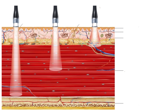 Hoachleistungslaser 12 Watt BTL 6000