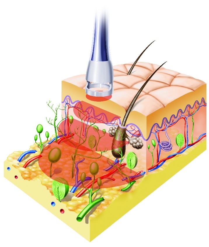 Hoachleistungslaser 12 Watt BTL 6000