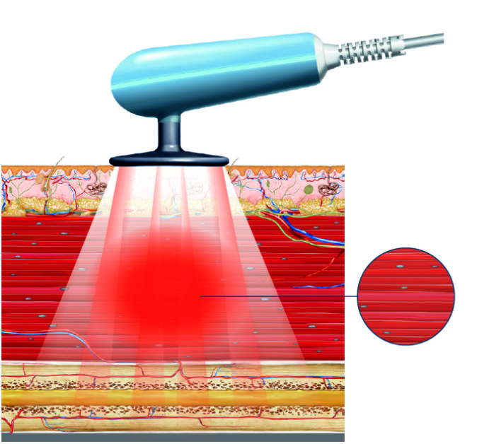 Radiofrequenztherapie BTL 6000 TR-Pro