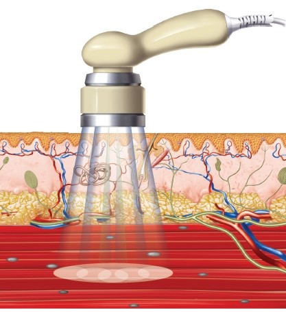 E009-2 Laser-Cluster für BTL 4000 Premium