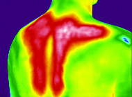 Radiofrequenztherapie BTL 6000 TR-Pro