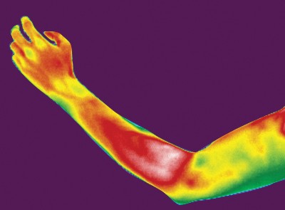 Radiofrequenztherapie BTL 6000 TR-Pro