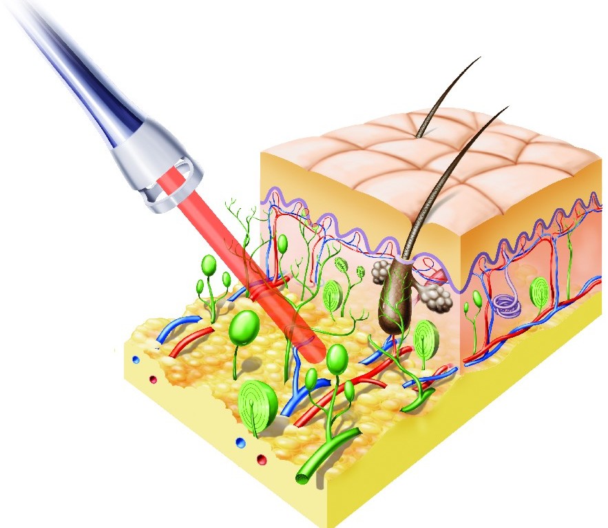 Hoachleistungslaser 12 Watt BTL 6000