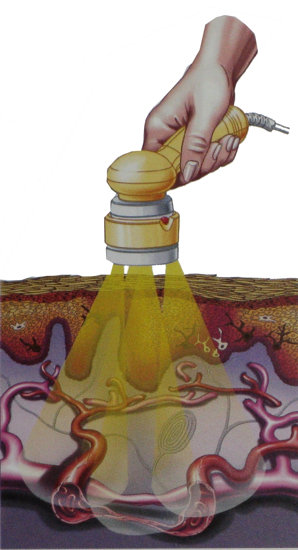 Anwendung Laser-Cluster für BTL 4000 Premium